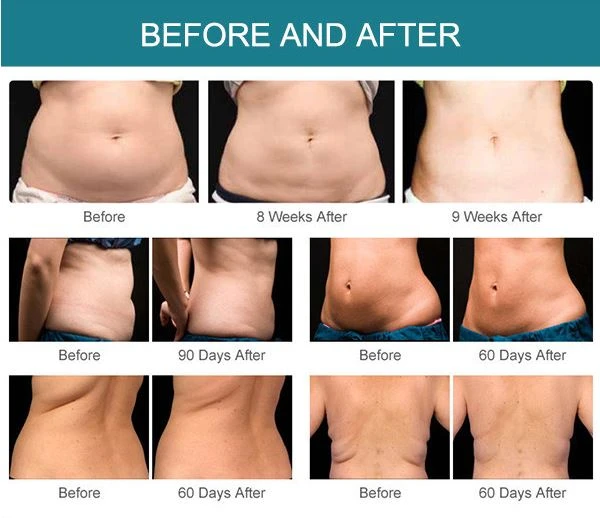 SaluShape Body Slimming And Face Lifting Machine SaluShape Body Slimming And Face Lifting Machine
